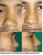 Before After Pictures,Nose job,Rhinoplasty,Delhi, augmentation rhinoplasty